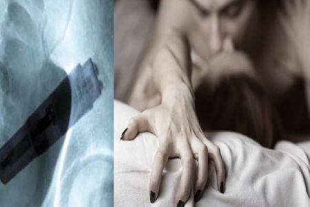 कामोत्तेजना के फेर में आंतों में चला गया वाइब्रेटर, डॉक्टर्स भी हैरान…