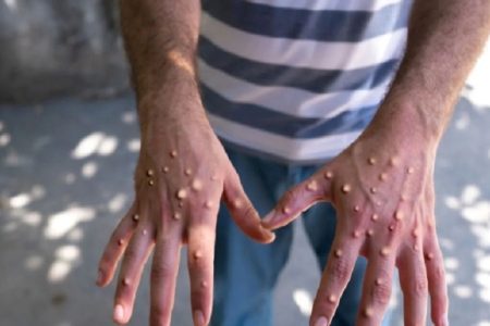 MPox Virus: पाकिस्तान तक पहुंचा Mpox वायरस, सऊदी से लौटा शख्स निकला संक्रमित