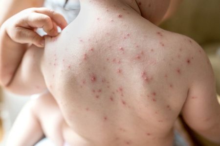 Monkeypox Virus ने भारत में दी दस्तक ? जानें इसके लक्षण और बचाव के तरीके
